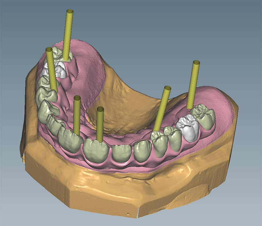 Computergrafik Implantatprothetik